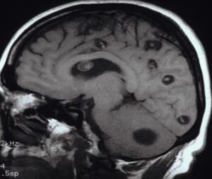 Brain riddled with taenia solium after